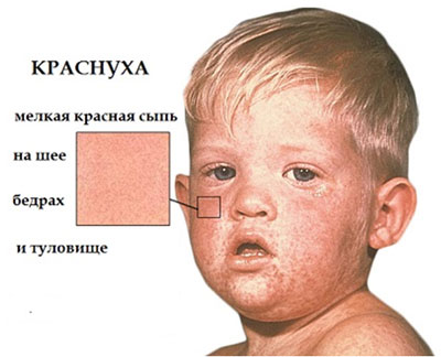 Календарь прививка от полиомиелита украина